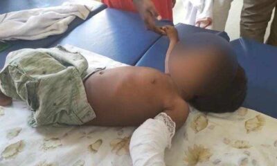 One and a half year old boy beaten by his mothers friend